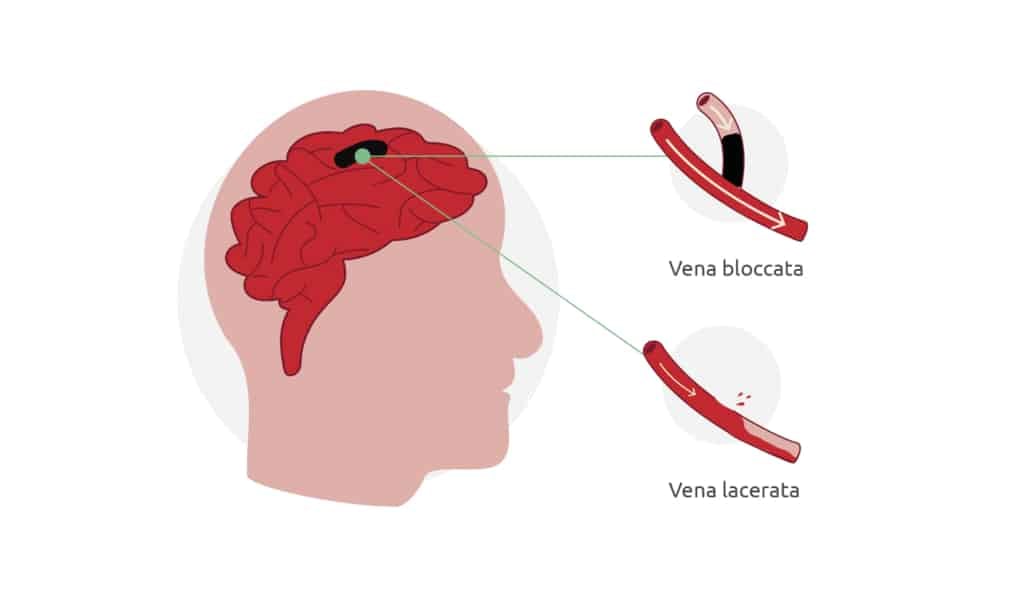 L'immagine mostra le cause di un ictus: un infarto cerebrale o un'emorragia cerebrale.