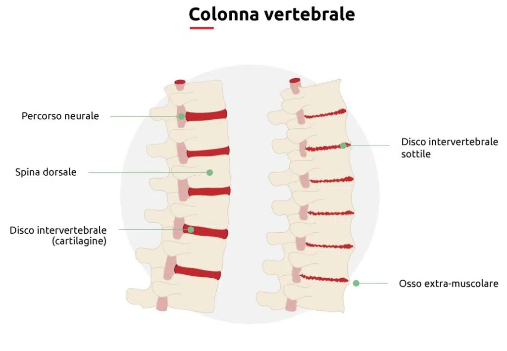 Una rappresentazione schematica di ciò che è l'artrosi alla schiena.