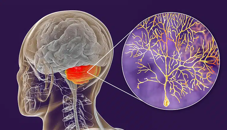 L'illustrazione mostra dove ha origine l'atassia cerebellare: nel cervelletto. 
