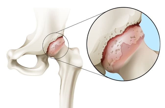 Una rappresentazione schematica di ciò che è l'osteoartrite all'anca: un'anca con osteoartrite.