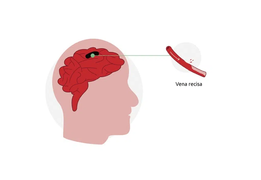 La rottura di un vaso sanguigno è la causa di un'emorragia cerebrale.