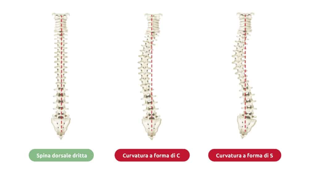 Una colonna vertebrale in posizione normale e dritta e le vertebre colpite da scoliosi in forma di C e S mostrano chiaramente come la scoliosi possa causare diversi sintomi fisici.