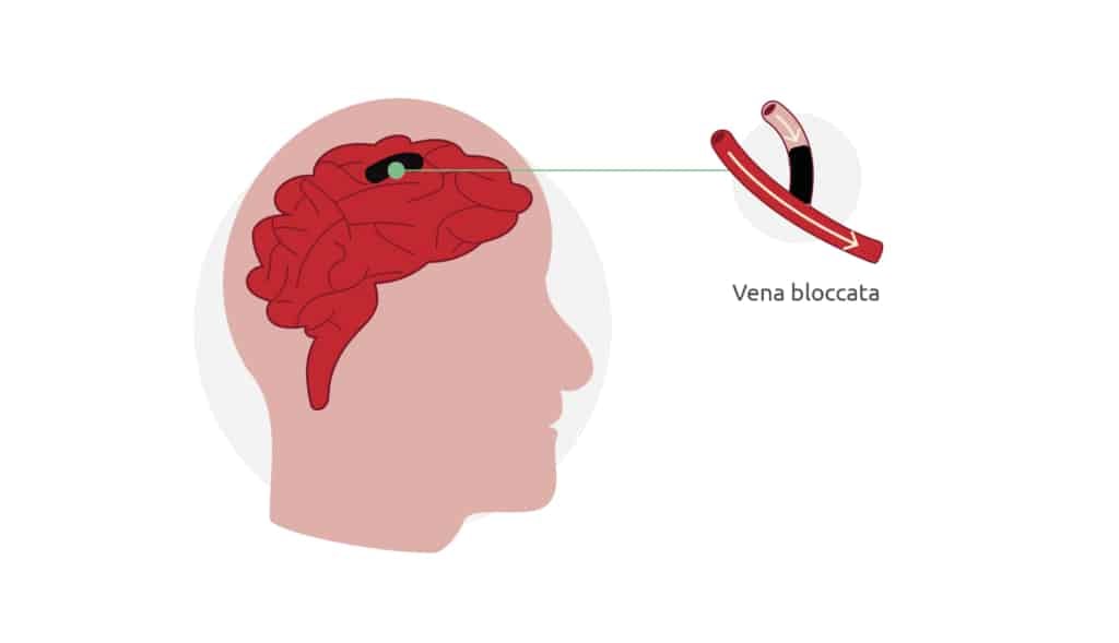 Un ictus si verifica quando un'arteria o una vena del cervello si blocca. Se l'ostruzione è momentanea parliamo di un TIA.